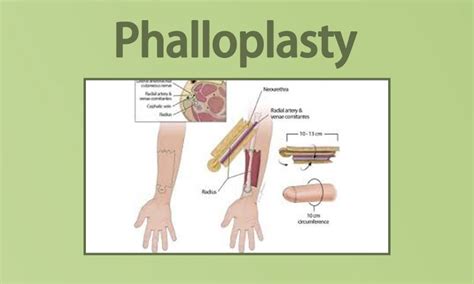 phalloplasty healed results|Photos .